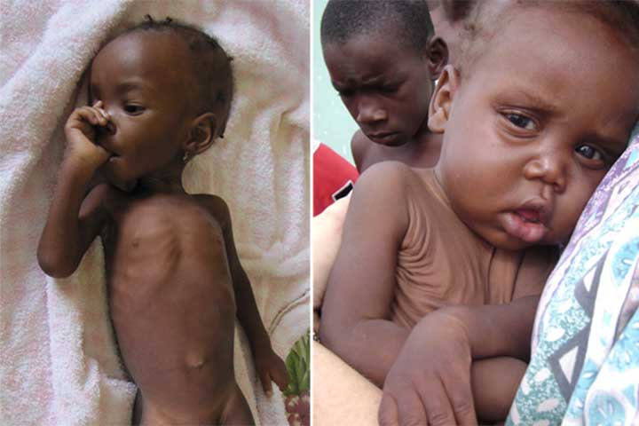 under-5-malnutrition