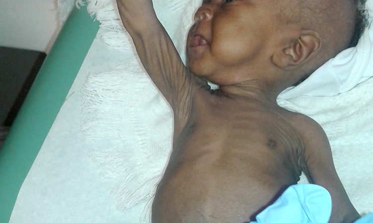 Malnourished Baby in Haiti