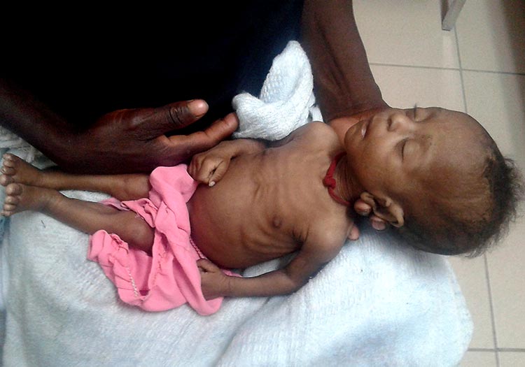 Severe malnutrition is slowly killing this tiny child.