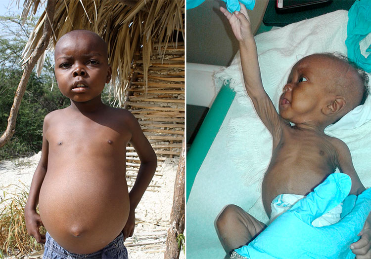 Malnutrition in Haiti is a complex problem that continues because of the cycle of poverty and other things we cannot control. There are two types of malnutrition that we see here: Kwashiorkor and Marasmus