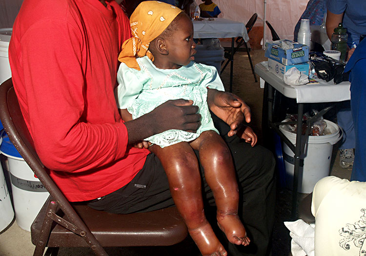 Child with severe malnutrition