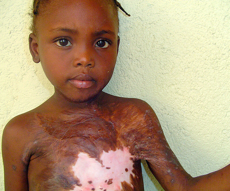 Love A Child child Dimelia scars from a childhood burn.
