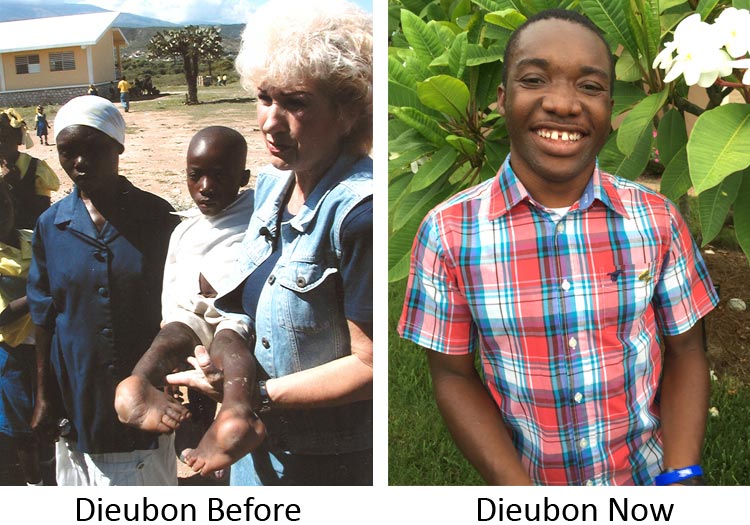 Dieubon before and after surgeries