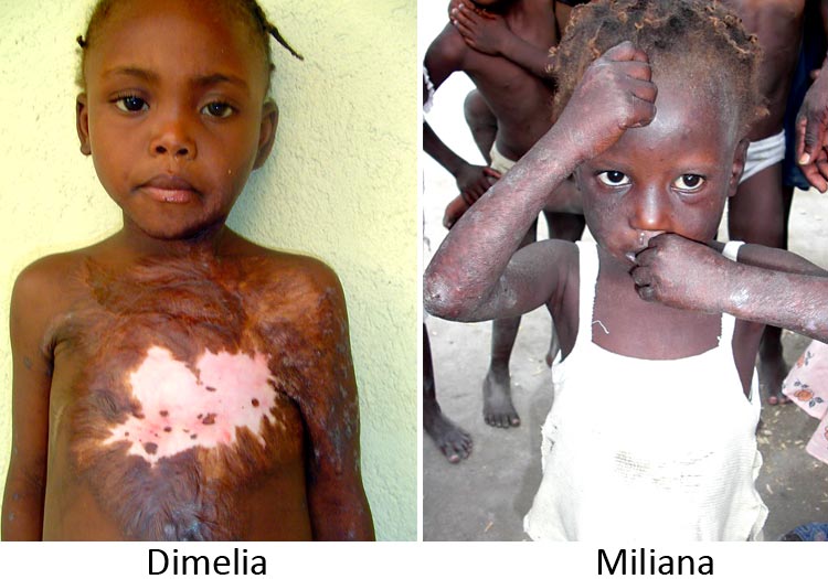 Love A Child children Dimelia and Miliana before surgery 
