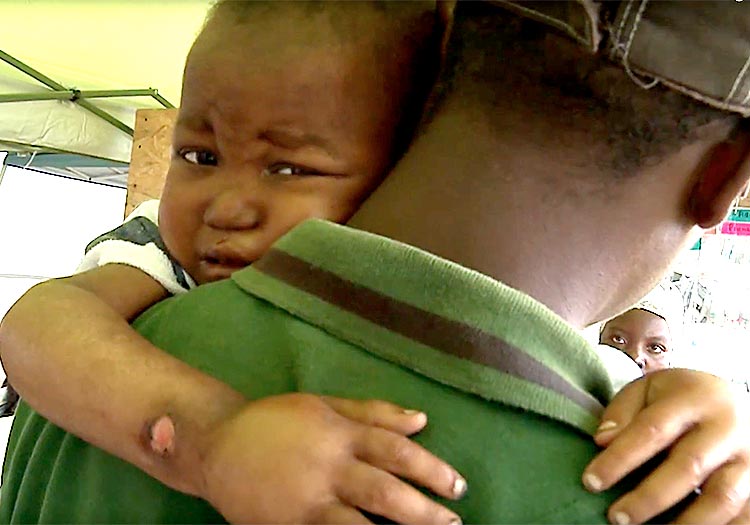 Young Haitian boy bloated because of severe malnutrition.