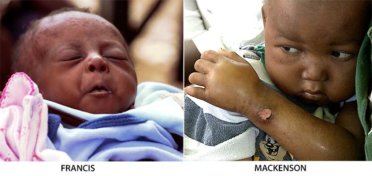 Francis and Mackenson suffer from two different types of malnutrition with little hope for survival.