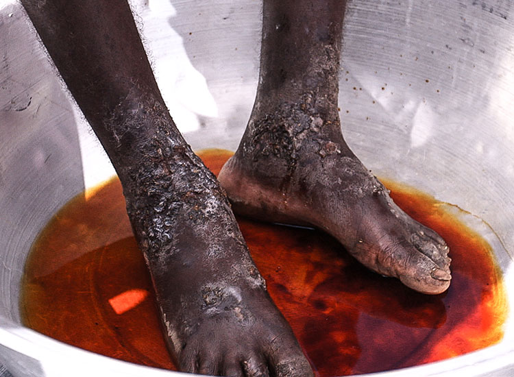 Haitian children with impetigo on his lower legs and feet and had been suffering from it for six years.