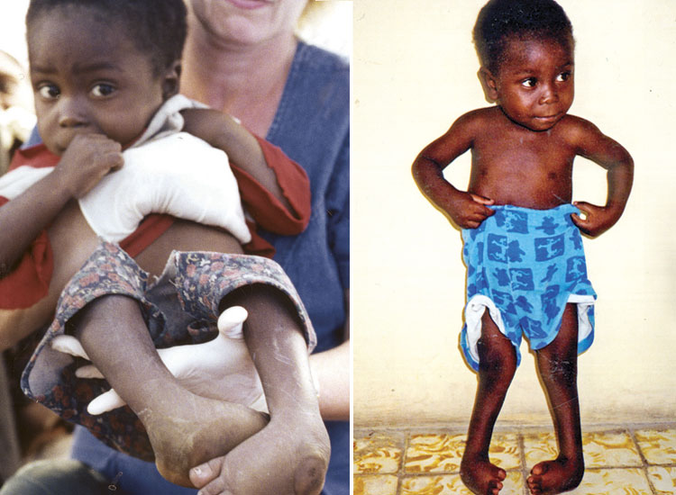 Dieuferly was born with bilateral club foot and was severely malnourished.