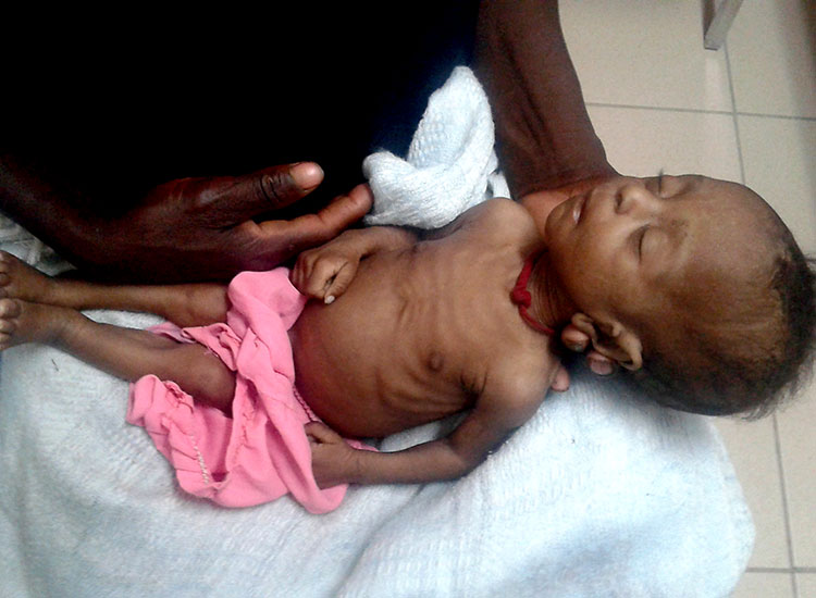 Child starving to death, needs Feeding Program.