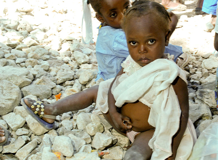 Many children suffer from malnutrition, and as a result, their hair turns red and brittle.