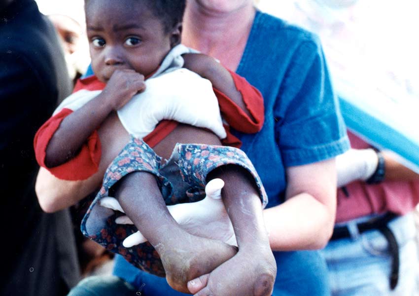 He was born with bilateral clubfoot and was severely malnourished.
