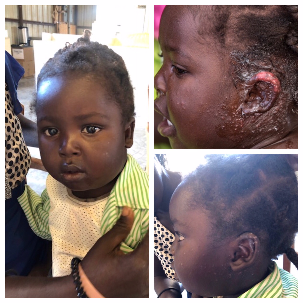 Child from Peyi Pouri Clinic – 01-29-18