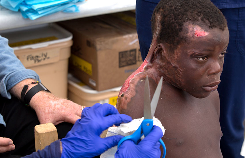 This little boy was severely burned, when he had a seizure and fell into a fire.