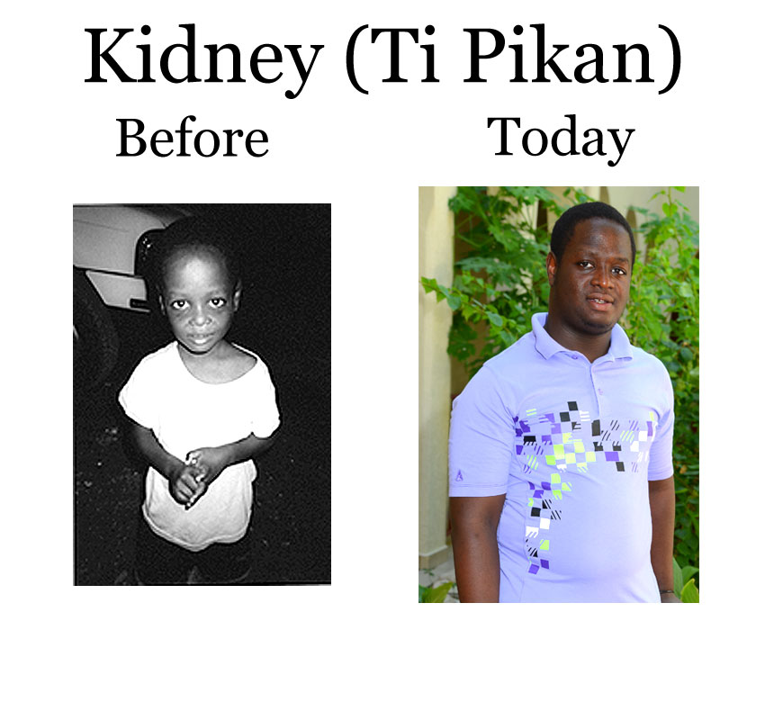 Update Kidney Francois – Ti Pikan