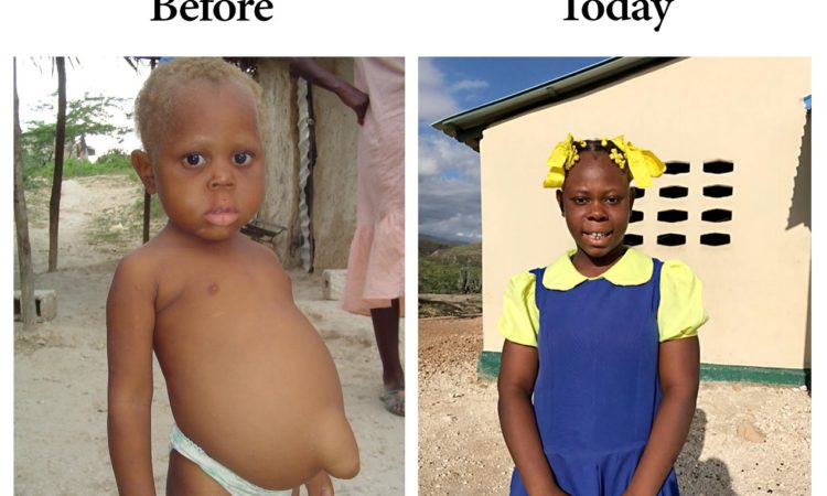 Malnourished Children Haiti