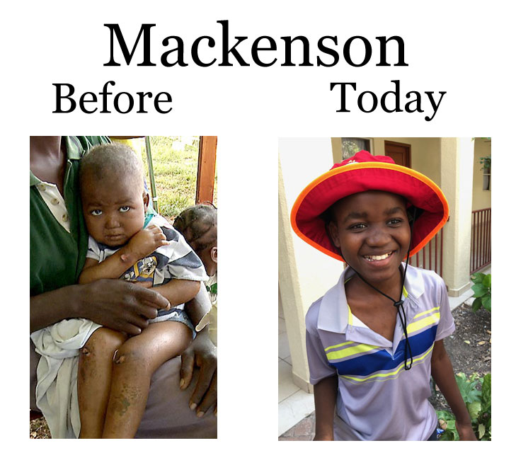 Update on Mackenson:  4-20-18  7:00 PM