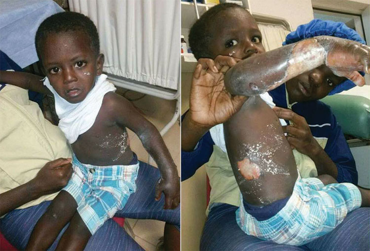 Treating burned child at the Jesus Healing Center.