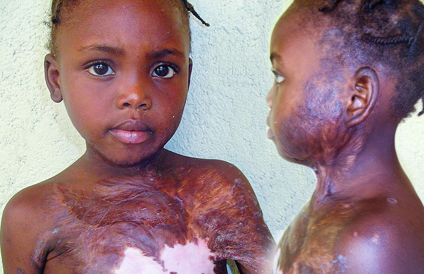 This beautiful child fell into a charcoal fire and a boiling pot of cornmeal.