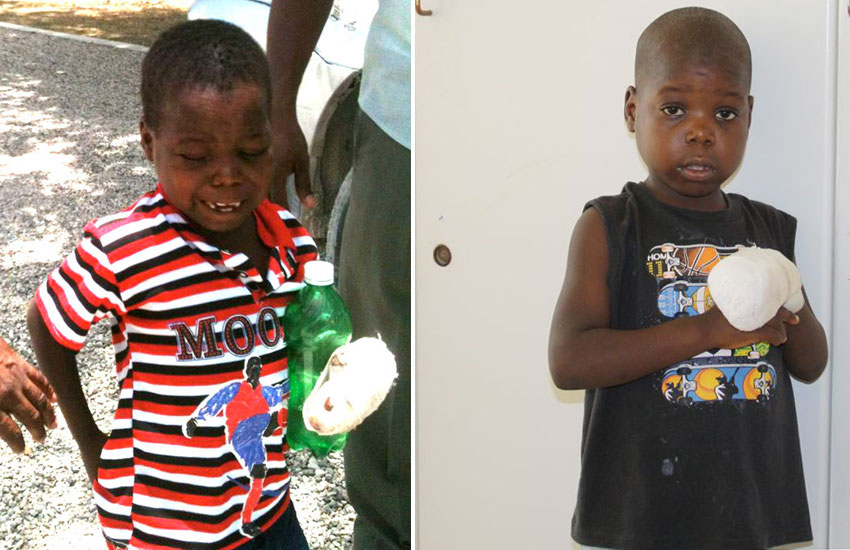 His father got angry and held his son’s hand in boiling water until the skin fell off.