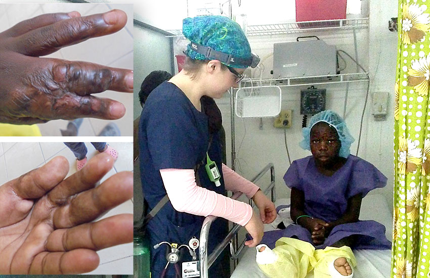 Lionel has received the needed medical care for his severely burned hand. 
