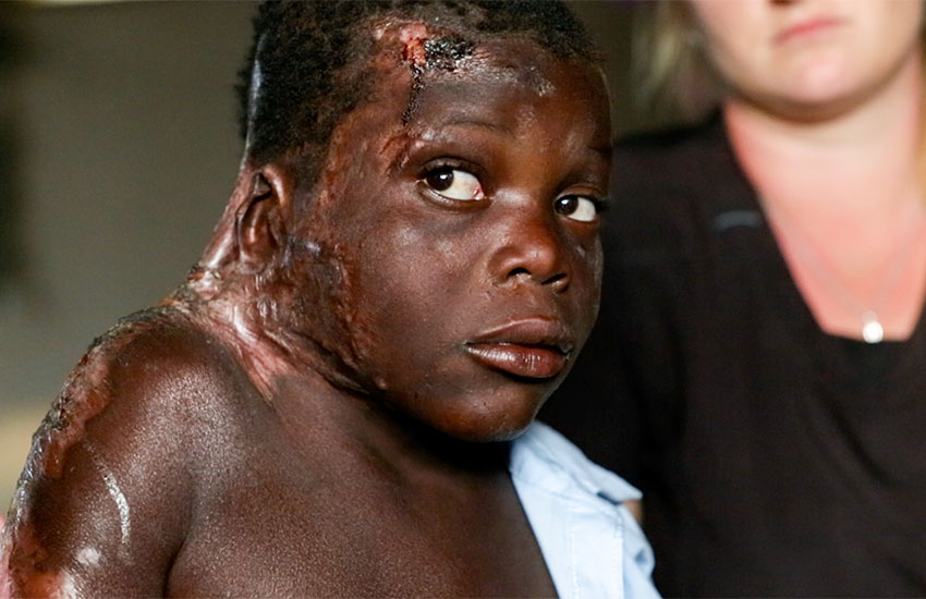 There are so many accidents of children falling into cooking fires here in Haiti.