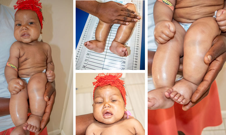 Kwashiorkor Malnutrition…