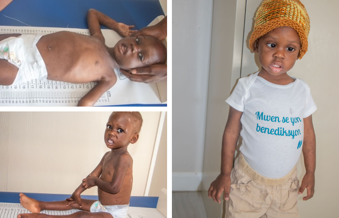 Malnutrition Goes Rampant in Haiti…