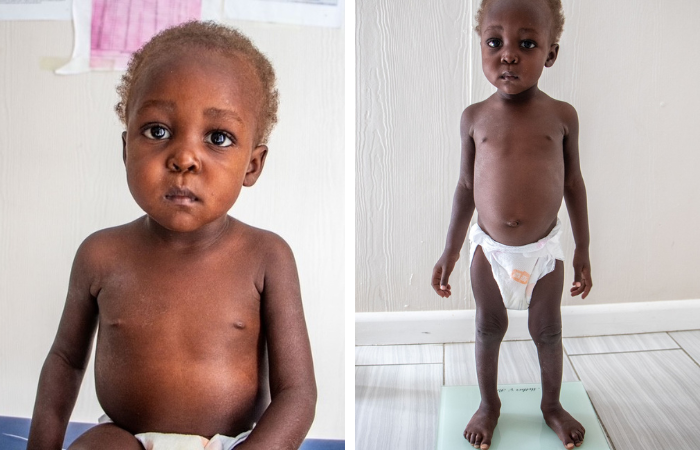 Haiti’s Malnutrition