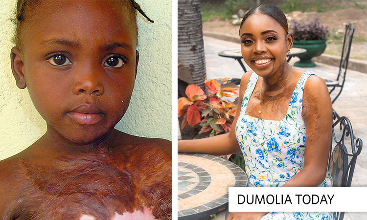 Dumolia (Dimelia) Shines!